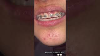 orthodontic changing .O ring #smiledentist #smile #dentalesthetics #musicsong #doctor