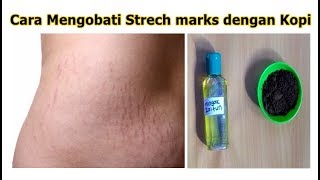 Cara Mengobati Strech mark dengan Kopi