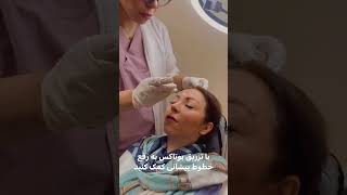 تزریق بوتاکس زیباجو عزیز #botox #botoxnatural #beauty #جوانسازی_صورت #جوانسازی_پوست