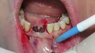 Block Graft + Tori Removal