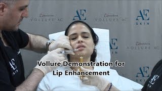 Vollure Demonstration 4 Lips - A E Skin - Encino, CA - 818-835-1833