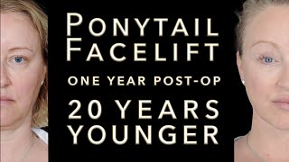 You Won't Believe This Before and After Video! Ponytail Facelift KAO Plastic Surgery