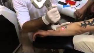 Q-switch nd yag laser for tattoo removal video