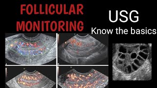 Follicular monitoring USG - The basics