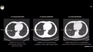 Pulmonary Nodule