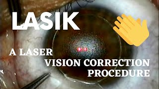 Performing a Lasik Vision Correction with Laser Eye Surgery [Quick!]