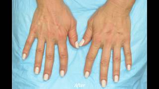 Hand Filler Using Restylayne Lyft - The Skin Center