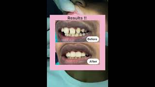 Dental gap closure දත් අතර ඇති හිදැස් පිරවීම Britanna Dental Clinic