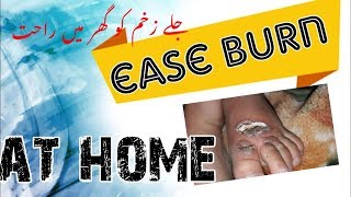 EASE YOUR BURN AT HOME , EFFECTIVE TREATMENT OF BURNS AT HOME ,URDU,HINDI