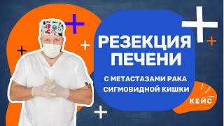 Дмитрий Савенков I Резекция печени I Рак сигмовидной кишки I Днепр