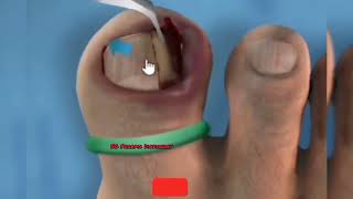 Ingrow Toe Nail Removal Surgery........😳😱.......😳😱.....🩸🩸....🩹🩹.....💊