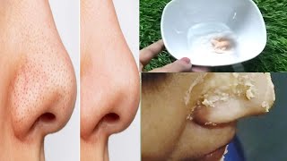 मुश्किल Blackheads Whiteheads को जड़ से खत्म करने के आसान उपाय | Home remedies - YouTube