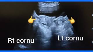 Bicornuate uterus with endometrial polyp in one horn or cornu, ultrasound, color Doppler management