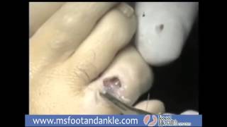 Hammertoe Implant x264