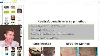 NeoGraft Hair Transplantation and hair loss treatment options