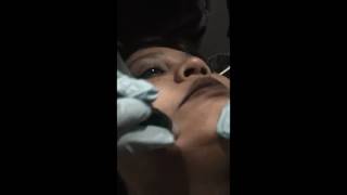 Medical Facial -  Microdermabrasion