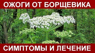 ОЖОГИ ОТ БОРЩИВИКА - СИМПТОМЫ И ЛЕЧЕНИЕ. ПЕРВАЯ ПОМОЩЬ ПРИ ОЖОГАХ БОРЩИВИКОМ