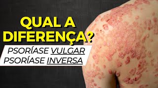 Diferenças entre psoríase VULGAR e psoríase INVERSA [CONHEÇA]