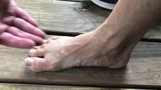 Short Foot - key treatment for foot and heel pain