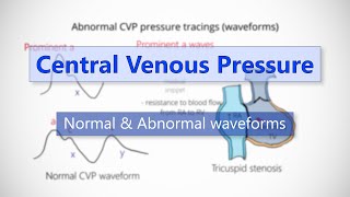 Central Venous Pressure (CVP) waveforms