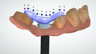 2015 Dental System   Custom Abutment and Positioning Guide