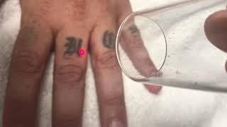 Hand tattoo, laser tattoo removal on fingers