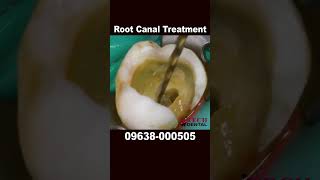 Root Canal Treatment  #foryou  #foryourpage #rootcanals #dental #tooth