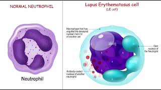 LE cell , LE body , LE cell phenomenon pathology mbbs