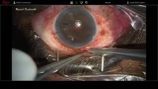 Secondary AC IOL - sutureless