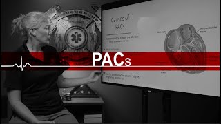 Premature Atrial Contractions (PACs)