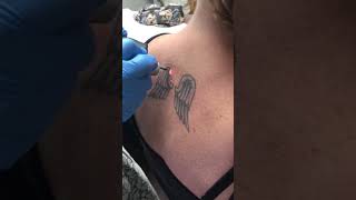 Laser tattoo removal of angel wings on back