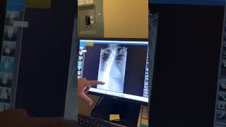 Scoliosis spinal fusion and chiropractic care