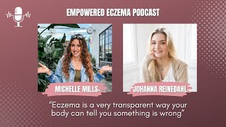 Podcast | Johanna, Eczema is Our Bodies Communicating With Us