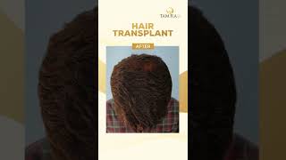 Your Permanent Solution to Balding - Hair Transplant! #hairlosstreatment #hairtransplantchennai