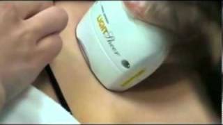 Laser Hair Removal, Intense Pulsed Light, Houston, (877) 65