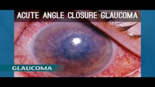 Glaucoma : All you need to know about Glaucoma by Saidat Sododo