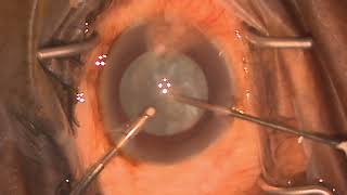 AJO - Video I&A decompression of intumescent cataract -Deshmukh’s Technique