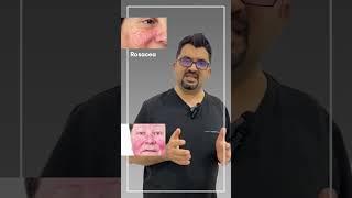 Rosacea #rosacea العد الوردي