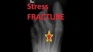 Prevent Foot Stress Fracture