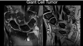 Tenosynovial Giant Cell Tumor