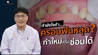 ครอบฟันหลุดต้องทำยังไง | Dentalimage