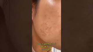 Como trato meu melasma: dicas eficazes para clarear manchas na pele