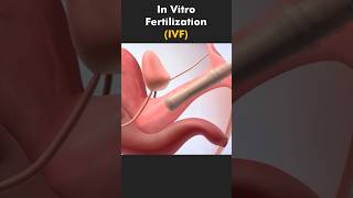 In Vitro Fertilization (IVF) Process 3DAnimation | #ivf #invitrofertilization #ivfprocess