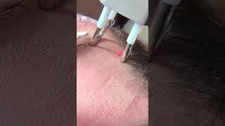 Frakčný CO2 laser Skin Resurfacing, "pixelácia" - A3Clinic