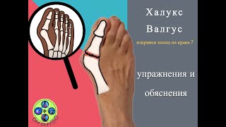 Изкривен Палец на Крака/ Hallux Valgus / Кажете Край На Болката! Причините, Упражнения и Лечение