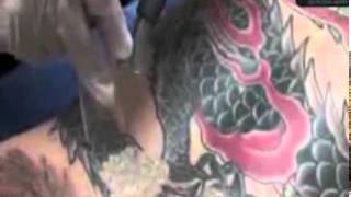 Laser Tattoo Removal, Tatoo Removal, Remove Tattoos, Salt L