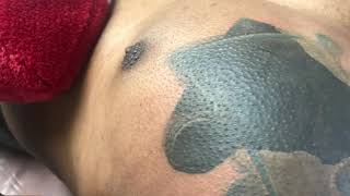 Laser tattoo removal of a Cover up tattoo on cheat of African American man