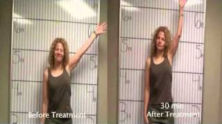 Frozen Shoulder Patient Amazing Natural Cure Before & After_7 Dallas, Texas