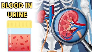 Understanding the Causes of Blood in Urine (Hematuria) for Better Health |What Causes Hematuria?