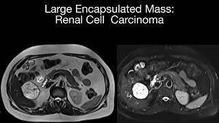 Renal Cell Carcinoma Case 10